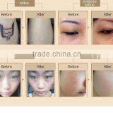 800mj New Styel Laser Picosure/laser Tattoo Removal Machine Price Pigmented Lesions Treatment thumbnail-5