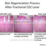 RF Co2 Fractional Laser Fractional Laser Treatment thumbnail-2