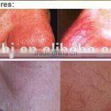 800mj 1064nm Long Pulse Nd Yag Laser For Varicose Veins Blood Vessel Spider Vein Treatment Permanent Tattoo Removal thumbnail-4