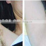 QTS Alexandrite Laser Hair Removal Machine Price With CE thumbnail-3