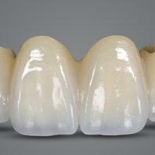 PFM.Zirconia Crown. flexible full acrylic denture.  CAPTEK Chinese Dental Lab Denture