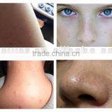 2017 Most Popular Blackhead Remover Vacuum Blackhead Remover thumbnail-6