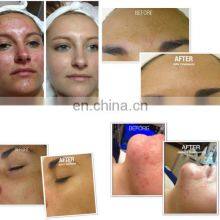 Ultrasonic Peeling Vacuum Spray Skin Rejuvenation Diamond Dermabrasion Face Care Microdermabrasion Machine thumbnail-5