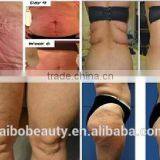 Vacuum Cold Zero Cryo Lipo Laser Machine/cryo Slimming Machine/cryo Liposuction Machine thumbnail-5