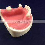 Medical Science Dental Implant Model With Soft Gingiva thumbnail-6