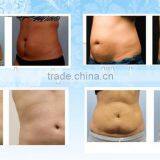 Slimming Reshaping Home Use /spa Good Effect Cool Sculpting Cryolipolysis Lose Weight Machine/laser Lose Weight(809nm Laser Led) thumbnail-5