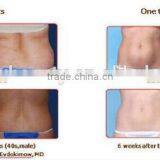 Popular Portable Fat Freezing Machine For Lose Weight thumbnail-6