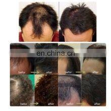 Korean Alopecia Rogaine Hair Regrowth Horse Hair Growth Tonic Laser System Machine Instrements Therapy Equipment in Pakistan thumbnail-2
