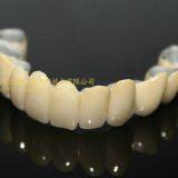 Dental Crown Porcelain Fused Metal, PFM, VMK, Dental Prostheses, Laboratoire Dentaire, Dentallabor, Laboratorio Dental, Dental Laboratory, Shenzhen LJ Dental Lab China thumbnail-2