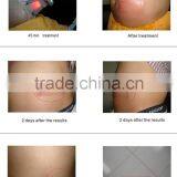 2016 Cryo Freeze Fat Cell Cooling Body Slimming Machine thumbnail-2