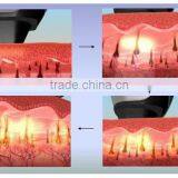 808nm Laser Hair Removal System thumbnail-3