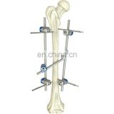 Quality Assured Basic Orthopedic Surgical Instrument Femoral Shaft External Fixator Medical Surgical Medical Instruments