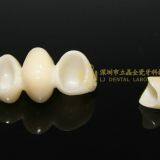 Dental Crown E.Max Ceramic, Porcelain Crown, Dental Veneers, Laboratoire Dentaire, Dentallabor, Laboratorio Dental, Dental Laboratory, Shenzhen LJ Dental Lab China thumbnail-5