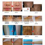 Permanent Factory Price 810nm Diode Laser For Hair Removal 810 Diode Laser Arm / Chest Hair Removal thumbnail-6