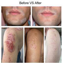 High Effective Solution 308nm Excimer Uvb Laser Vitiligo Treatment Device for Psoriasis and Vitiligo thumbnail-5