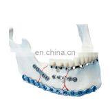 Locking Plate Maxillofacial Surgery Instruments thumbnail-1