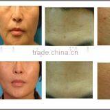 News Arrival!!! Portable Face Lift Micro Needle Fractional rf Machine for Skin Tighten and Wrinkle Removal thumbnail-6