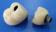 Dental Telescope Denture, Telesope Crown, Dental Prothesis, Laboratoire Dentaire, Dentallabor,Dental thumbnail-4