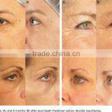 Sanhe Fractional Laser Co2 Skin Tightening System/ Dermatology thumbnail-6