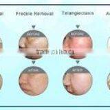 Acne Removal Stationary Ipl Shr Vertical /ipl Shr Machine/ipl Shr For Salon thumbnail-5