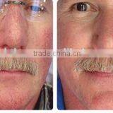 Beijing New Product 30W Diode Laser 980nm Vascular Vein Stopper Spider Vein / Laser Vascular Removal Machine / Laser for Face thumbnail-6