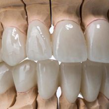 Aesthetic Dental All Porcelain IPS Emax Bridge