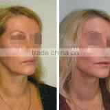 Professional Skin Clean Appliance Water Microdermabrasion and Diamond Head Dermabrasion Beauty Facial Machines thumbnail-4