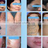 Q Switched Laser Machine Q-switched Nd Yag Laser Q Switch Laser Tattoo Removal Machine For Tattoo Removal With CE thumbnail-6