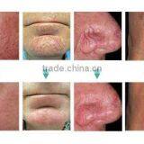 Spider Vein Removal Machine thumbnail-5