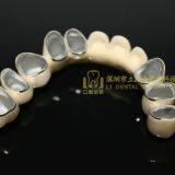 Dental Crown Porcelain Fused Metal, PFM, VMK, Dental Prostheses, Laboratoire Dentaire, Dentallabor, Laboratorio Dental, Dental Laboratory, Shenzhen LJ Dental Lab China thumbnail-3