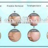 Skin Whitening Professional Vertical Ipl SHR Hair Removal Device 515-1200nm / SHR Spare Parts Hair Removal Machine For Promotion 590-1200nm thumbnail-5