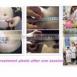 BL-A Liposonix Body Slimming System thumbnail-6