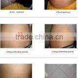 HOT SELLING !!Fat Frozen Equipment Cryolipolysis Slimming Equipment thumbnail-6