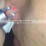 Newly Designed Spa Wanted High Frequency 980nm Laser Spider Vein Removal Machine thumbnail-4