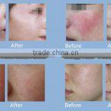 980nm Diode Laser Rosacea and Melasma Remover Machine thumbnail-3
