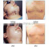 Portable Top Quality Elight Machine Needle Free Bio Skin Rejuvenation thumbnail-3