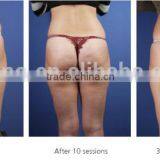 2016 Best Fast Pain Relief Cellulite Removal Shock Wave Acoustic Wave Machine thumbnail-6