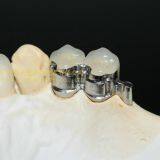 Dental Precision Attachment, Dental Attachment, Dental Denture, Laboratoire Dentaire, Dentallabor, Laboratorio Dental, Dental Laboratory, Shenzhen LJ Dental Lab China thumbnail-2