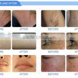 FDA Approved 2 Years Warranty 3000W ABS Ipl Shr Hair Removal Machine thumbnail-6