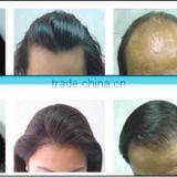 World Best Hair Regrowth Products/laser Hair Regrowth Machine for Hair Loss thumbnail-6