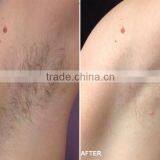 Special Design Apolomed HS-650 IPL SHR Laser Permanently Hair Removal IPL thumbnail-6