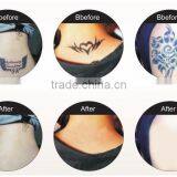 Body Care Equipment Machine Q Switch Varicose Veins Treatment Nd Yag Laser Tattoo Removal Machine Nd Yag Laser Machine thumbnail-4