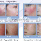 China Top Ten Selling Products Vascular Vein Removal / Varicose Veins Laser Treatment Machine thumbnail-3