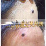 2015 New Wholesale Professional Mini Tatoo Spot Mole Laser Remover Freck Spot Removal Laser Pen thumbnail-4