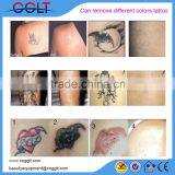 Laser Tattoo Removal Victory thumbnail-6