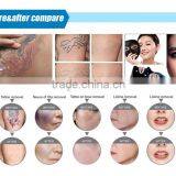 Hot Selling Import Laser Bar Portable Q-switched Nd:yag Laser Tattoo Removal Device thumbnail-6