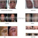 Freckle Removal Tattoo Removal Hair Removal 1064 nm 532nm nd Yag Laser thumbnail-6