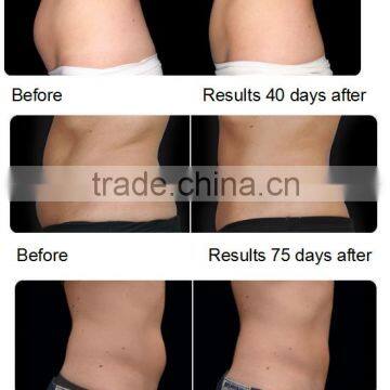 2017 CE Approval Vacuum Fat Freezing Advanced Cryo for Slimming, Cryo Slimming Machine CoolPlas