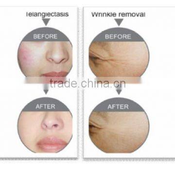 SUSLASER Elight Laser Hair Removal Machine photo-5