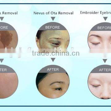 Hot Selling F12 Q-switched nd Yag Laser Skin Carbon Rejuvenation photo-2